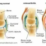 6 Tips Terbaik Menghilangkan Nyeri Sendi Di Lutut