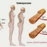 Bahaya Dan Faktor Resiko Penyakit Osteoporosis