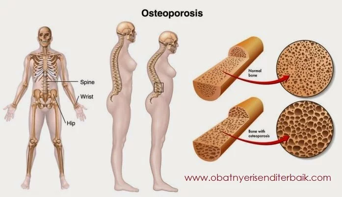 Bahaya Dan Faktor Resiko Penyakit Osteoporosis