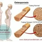 Obat Herbal Untuk Penderita Osteoporosis