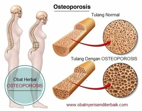 Obat Herbal Untuk Penderita Osteoporosis